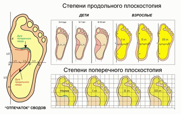 Плоскостопие.